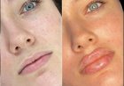 Best Doctors in dubai for Fillers: Treatment Areas and Benefits