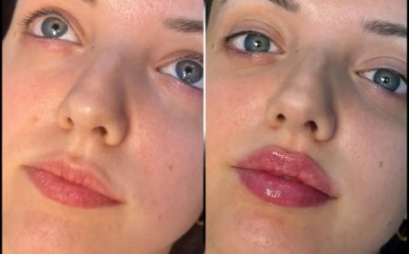 Why Choosing the Best Plastic Surgeon in Dubai Matters for Lip Fillers