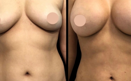 Inside Dubai’s Best Breast Augmentation Surgeons