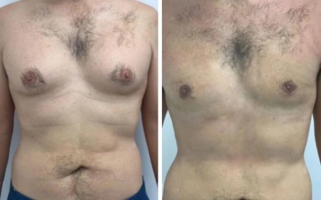 The Benefits of Choosing the Best Gynecomastia Surgeons in Dubai for Your Surgery