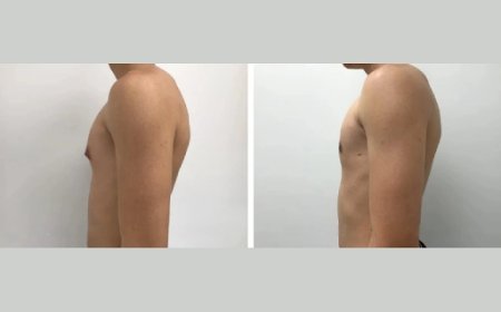 Can Gynecomastia Go Away on Its Own? Facts for Dubai Residents