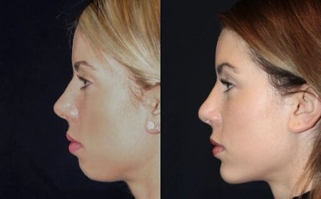 Best Doctors in dubai for Chin Fillers: The Secret to a Chiseled Chin