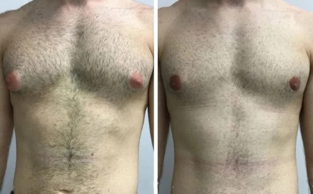 Choosing the Right Clinic for Gynecomastia in Dubai: A Patient’s Guide