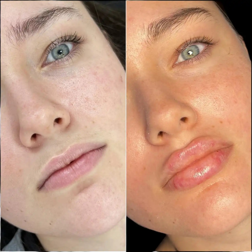 Enhance Your Beauty with the Best Plastic Surgeons in Dubai for Fillers
