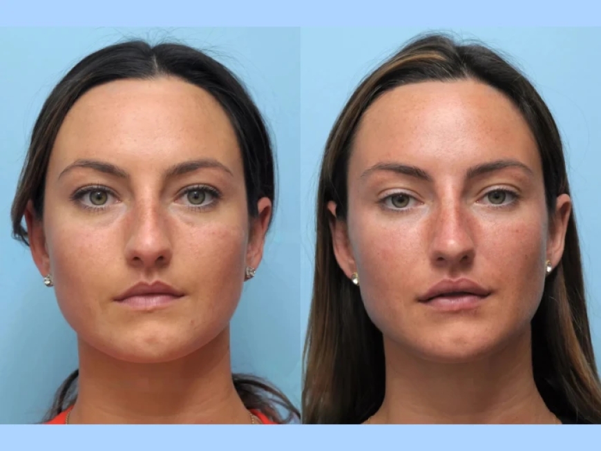 The Power of Subtle Lifts by the Best Doctors in Dubai for Thread Lift