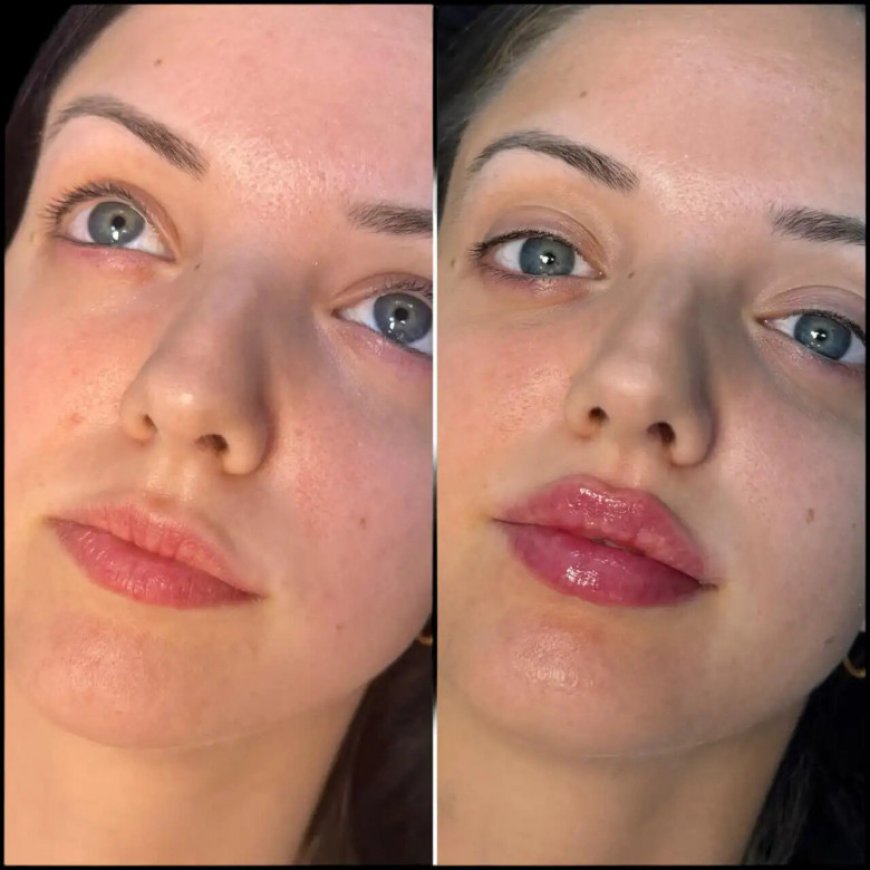 Why Choosing the Best Plastic Surgeon in Dubai Matters for Lip Fillers