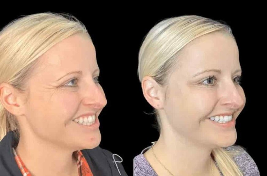 Experience Youthful Skin with the Best Plastic Surgeon in Dubai for Botox