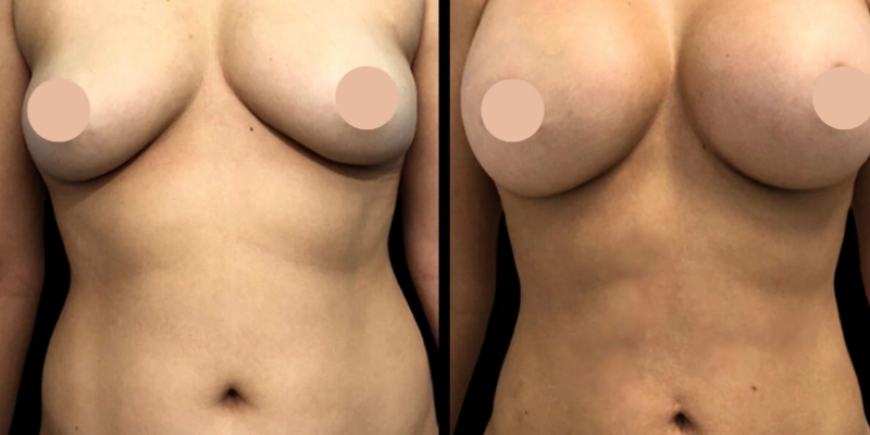 Inside Dubai’s Best Breast Augmentation Surgeons