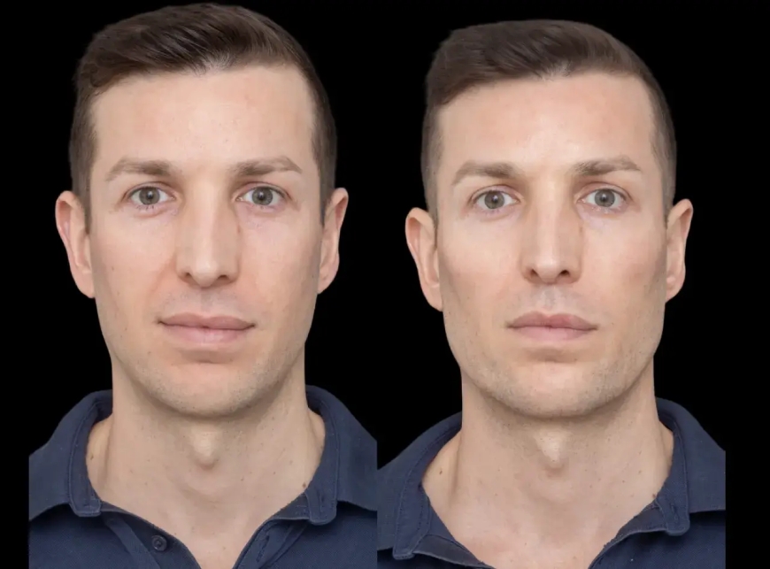 The Most Popular Cheek Fillers Treatment in Dubai for Long-Lasting Results