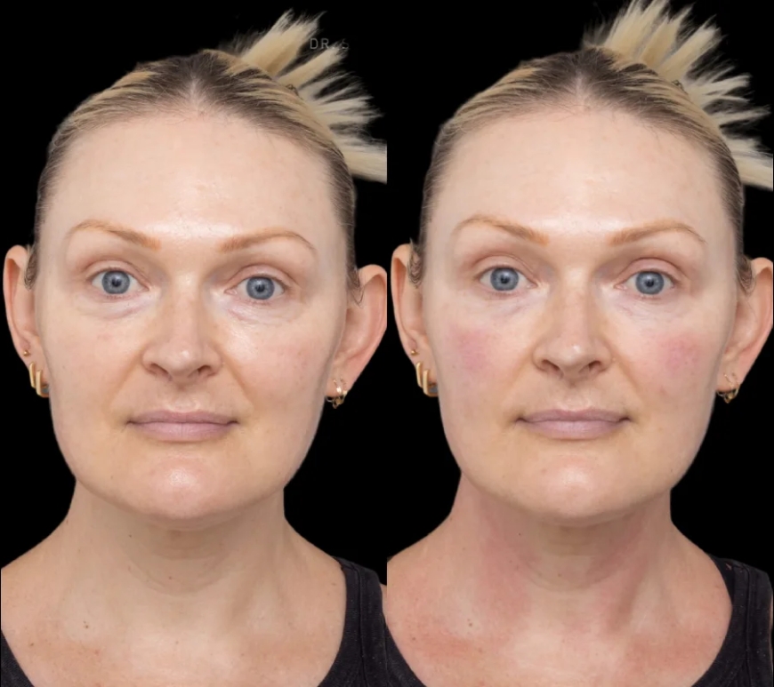 How to Find the Right Under Eye Fillers Treatment in Dubai