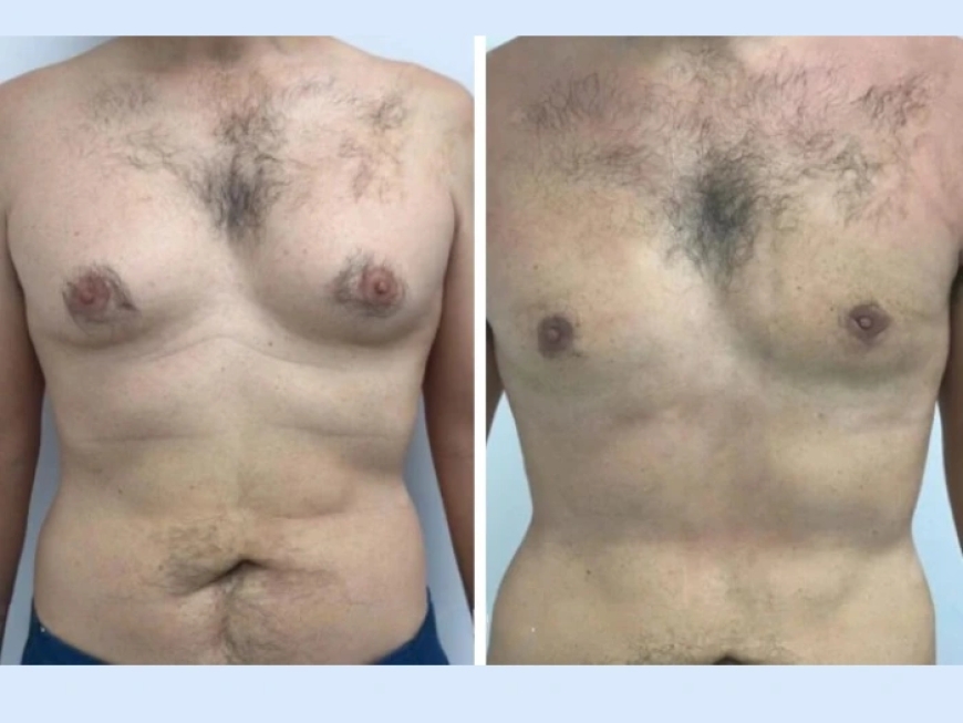 The Benefits of Choosing the Best Gynecomastia Surgeons in Dubai for Your Surgery