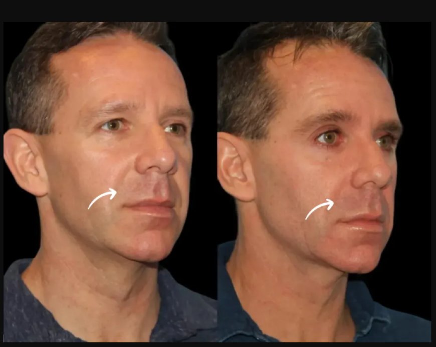 Say Goodbye to Smile Lines with Sculptra Fillers Treatment in Dubai