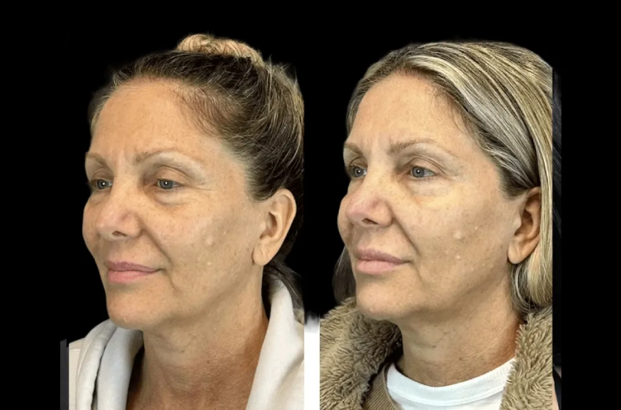 How Long Does Botox Treatment in Dubai Last? A Detailed Guide