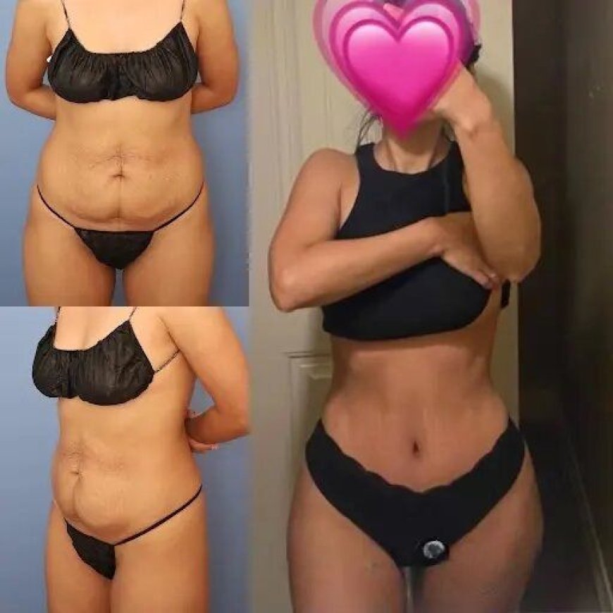The Best Tummy Tuck Surgeons in Dubai: Your Guide to a Sculpted Body