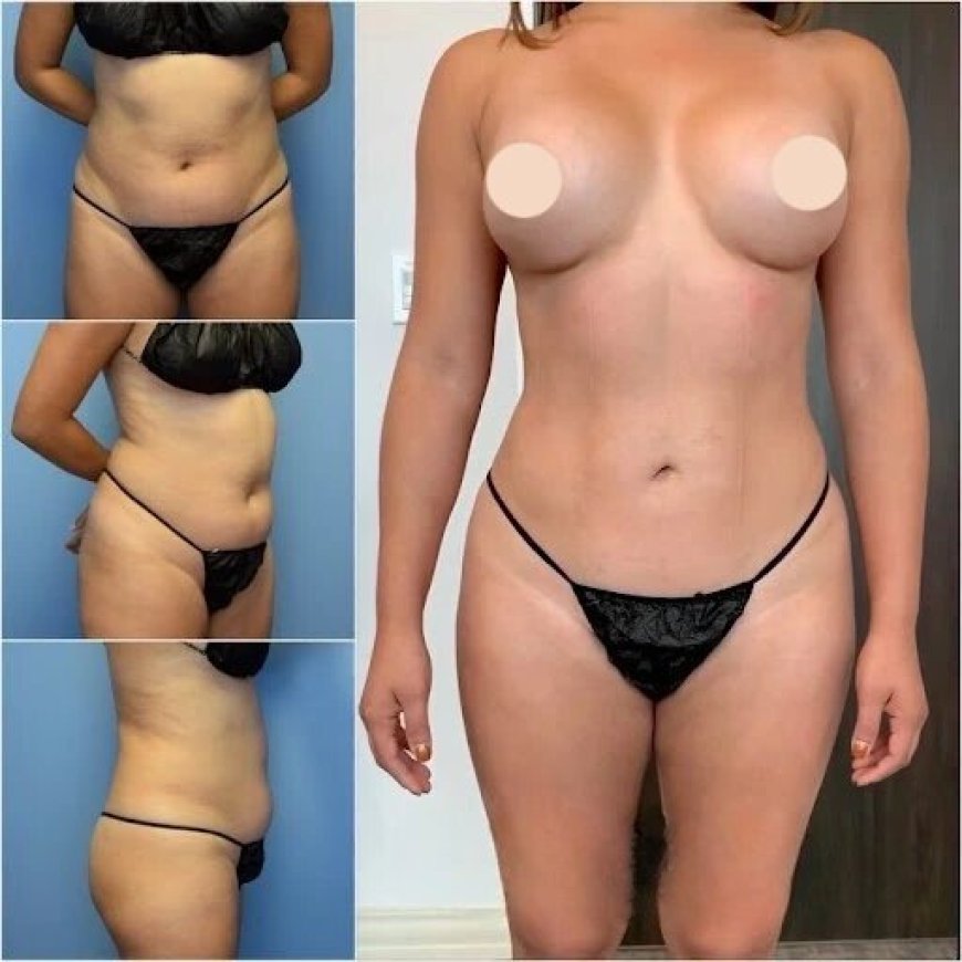 How Best Body Contouring Surgeons in Dubai Deliver Stunning Body Contouring Results