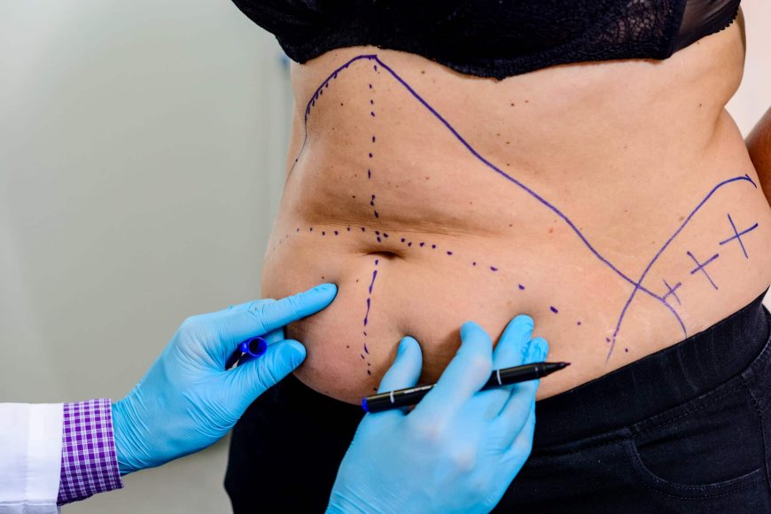 Mommy Makeover Surgery: What to Expect Before, During, and After