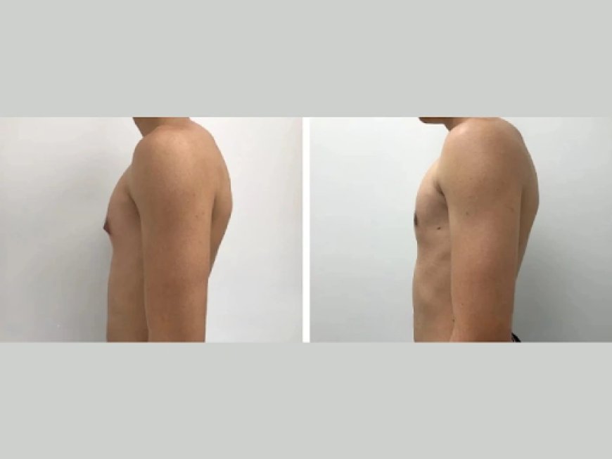 Can Gynecomastia Go Away on Its Own? Facts for Dubai Residents