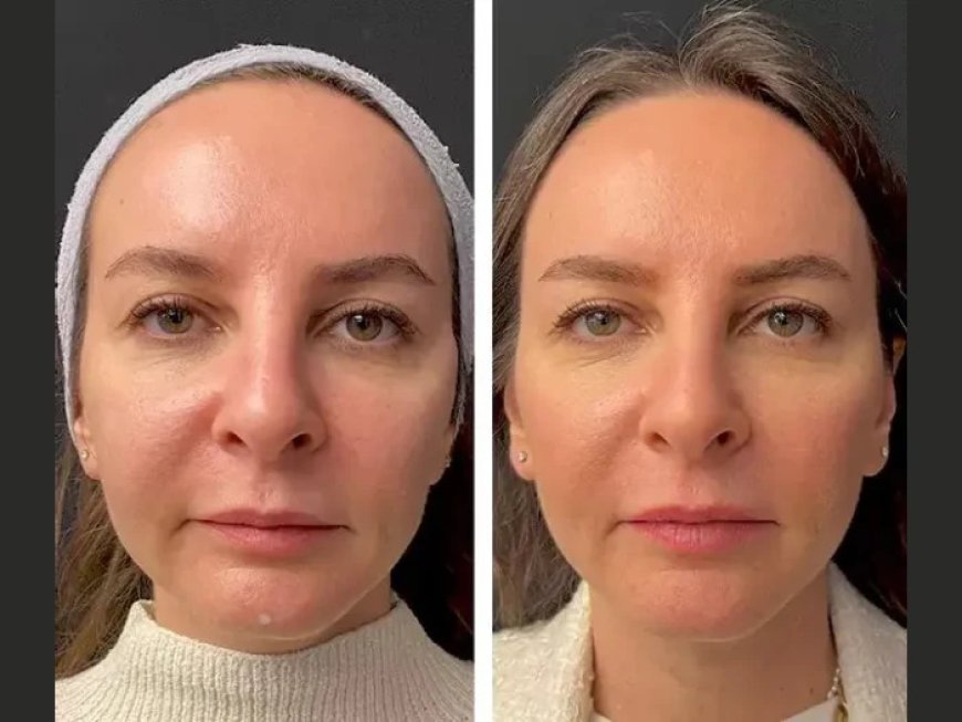 Common Myths About Mesotherapy Debunked by the Best Doctors in Dubai