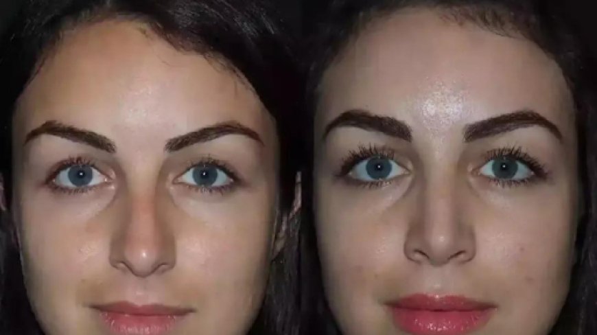 The Role of Technology in Modern Rhinoplasty in Dubai
