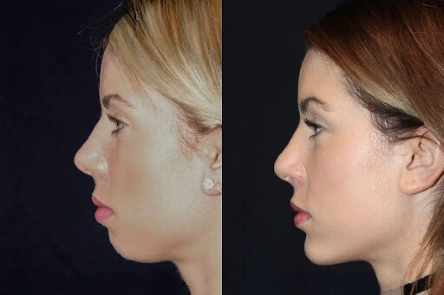 Best Doctors in dubai for Chin Fillers: The Secret to a Chiseled Chin