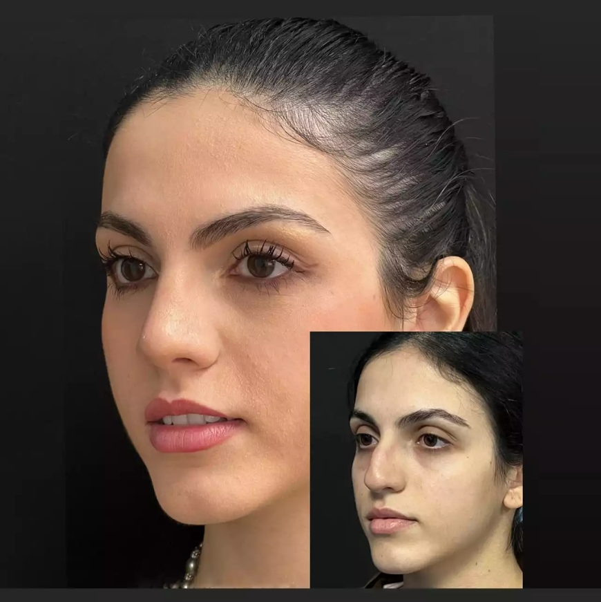 Best Septoplasty Surgeons in Dubai: How to Choose Wisely