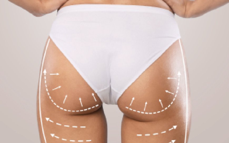 How Butt Fat Transfer in Dubai Can Enhance Your Curves Without Implants