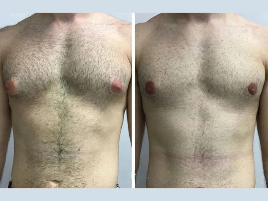 Choosing the Right Clinic for Gynecomastia in Dubai: A Patient’s Guide