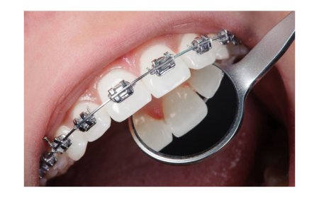 A Guide to Affordable Orthodontic Treatment in Saskatoon: What You Need to Know About Payment Plans