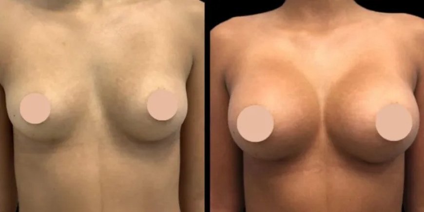 Breast Augmentation Surgery in Dubai: Can Implants Improve Breast Shape