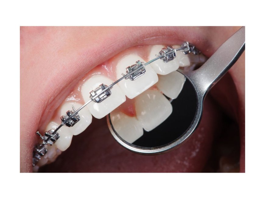 A Guide to Affordable Orthodontic Treatment in Saskatoon: What You Need to Know About Payment Plans