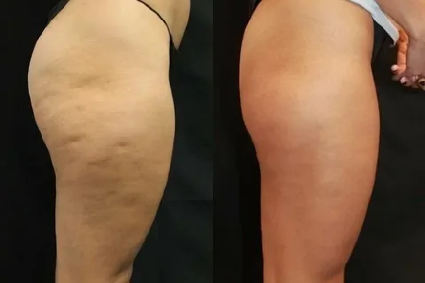 Smooth Skin, Confident You: Exploring Cellulite Treatment in Plano, Texas