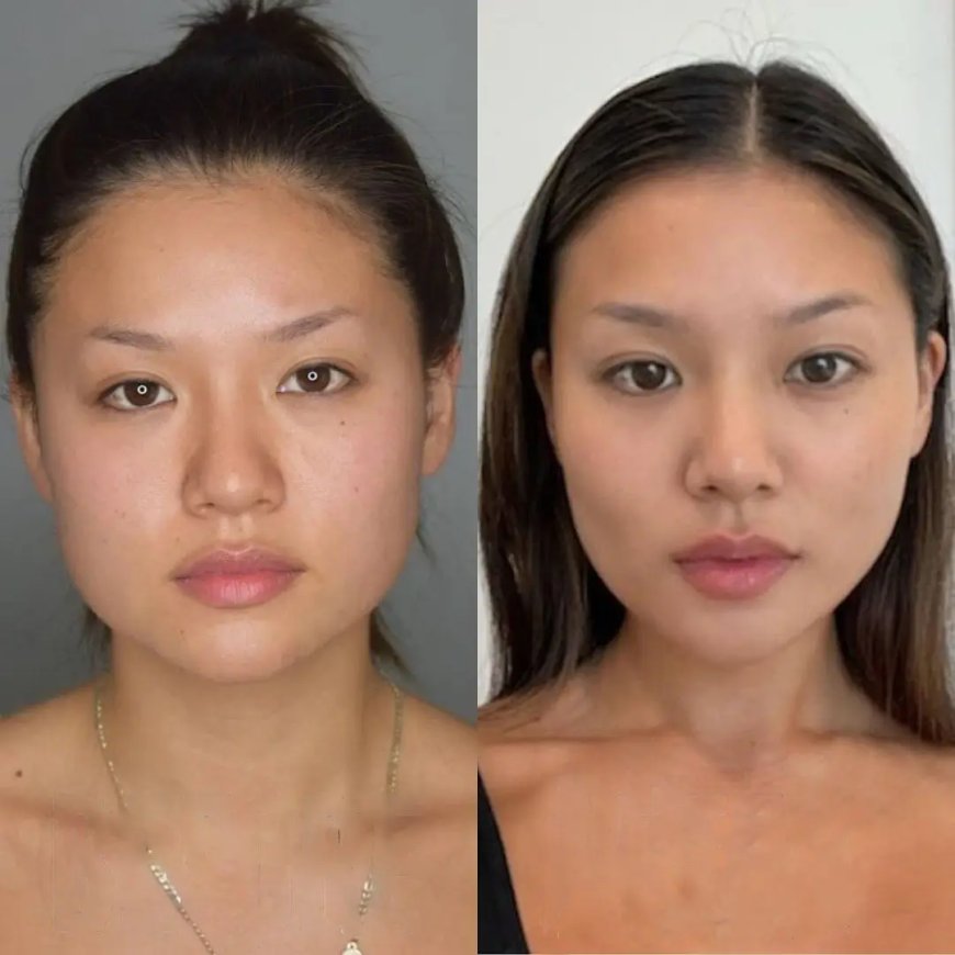 Buccal Fat Removal and Makeup: Tips from the Best Buccal Fat Removal Surgeon in Dubai