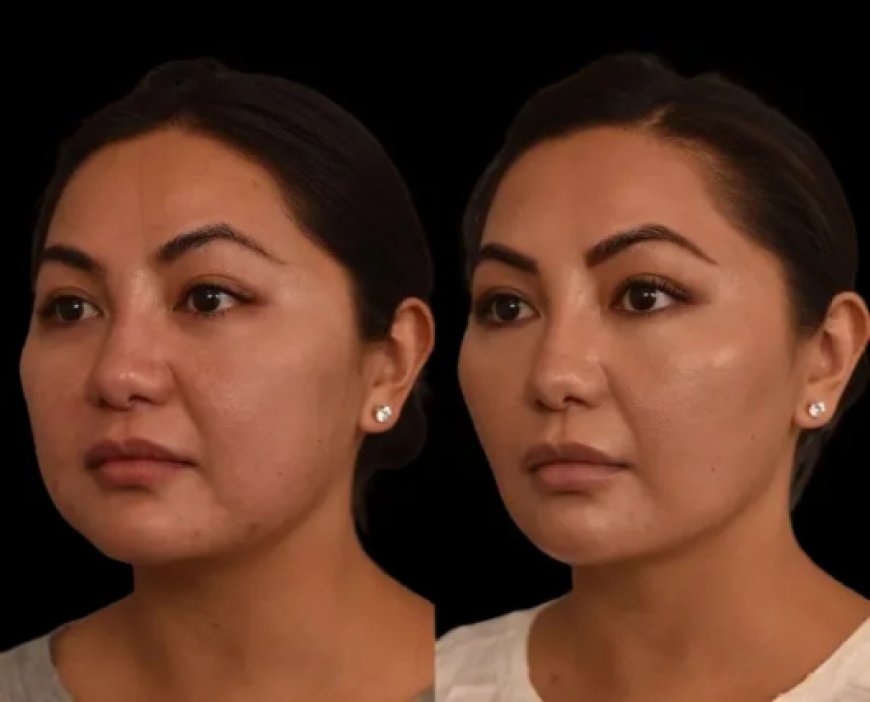 Double Chin Removal for the Summer: What You Need to Know from the Best Double Chin Removal Surgeon in Dubai