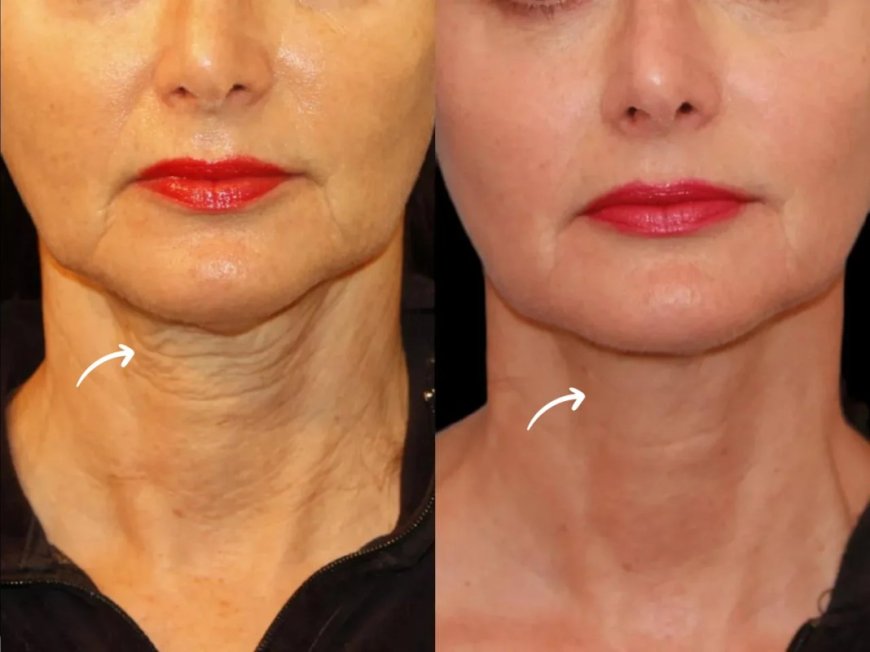Best Doctors in Dubai Demonstrate Layering Methods in Sculptra Fillers
