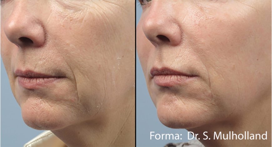 Achieve Youthful Radiance with Advanced Skin Tightening in Tysons Corner